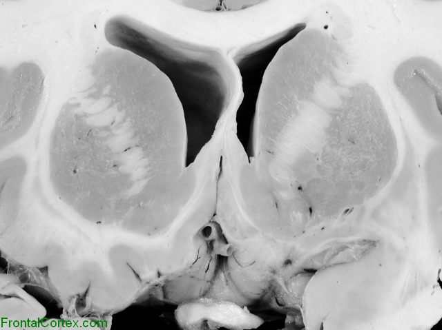 Basal Ganglia Coronal Close